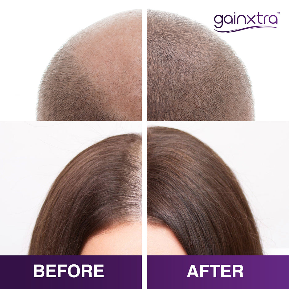 5% Minoxidil Hair Regrowth Treatment Spray
